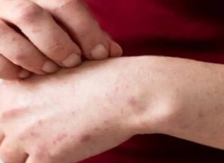 Brote de sarampión sigue en aumento en México