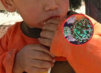 Virus coxsackie se propaga en México, ¿deja secuelas y cómo atenderlo?