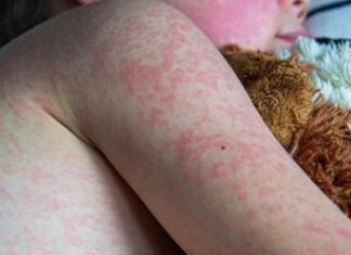 Sarampión brota en los 32 estados del país; Puebla reporta caso