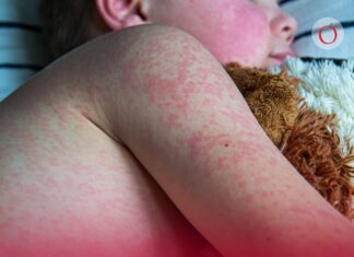 Sarampión: el síntoma clave que lo delata antes del salpullido y cómo distinguirlo de COVID-19 e influenza
