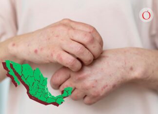 Gobierno dejó de gastar 70 % de recursos destinados a vacunas incluidas para Sarampión : PAN